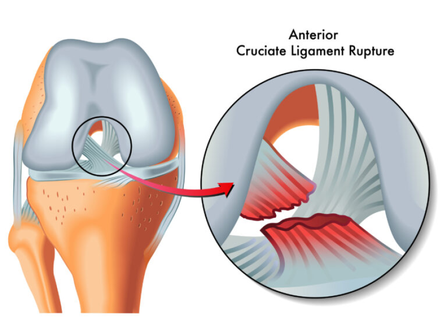 Anterior Cruciate Ligament Injuries Market: Size, Trends, and Strategic Insights