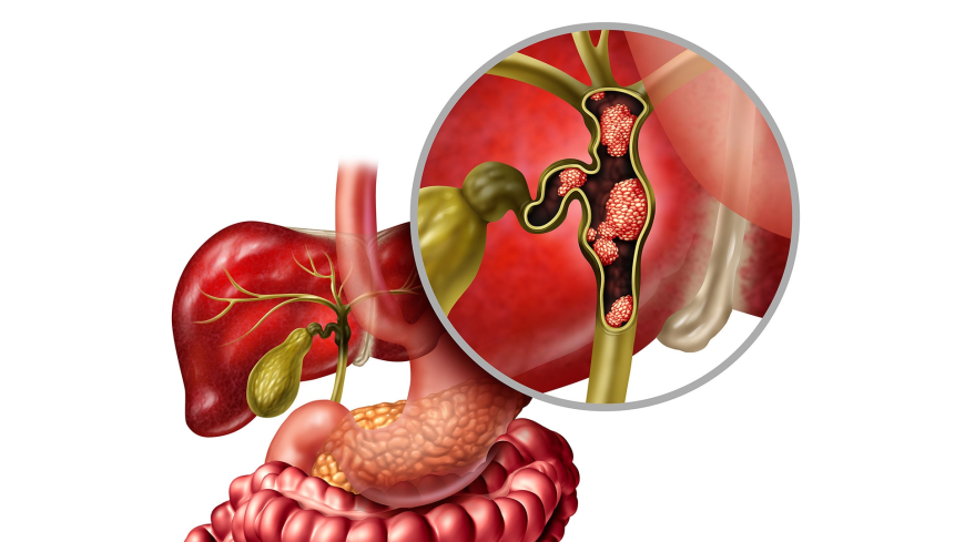 Biliary Tract Cancers Market Size, Trends, and Strategic Insights 2025-2032
