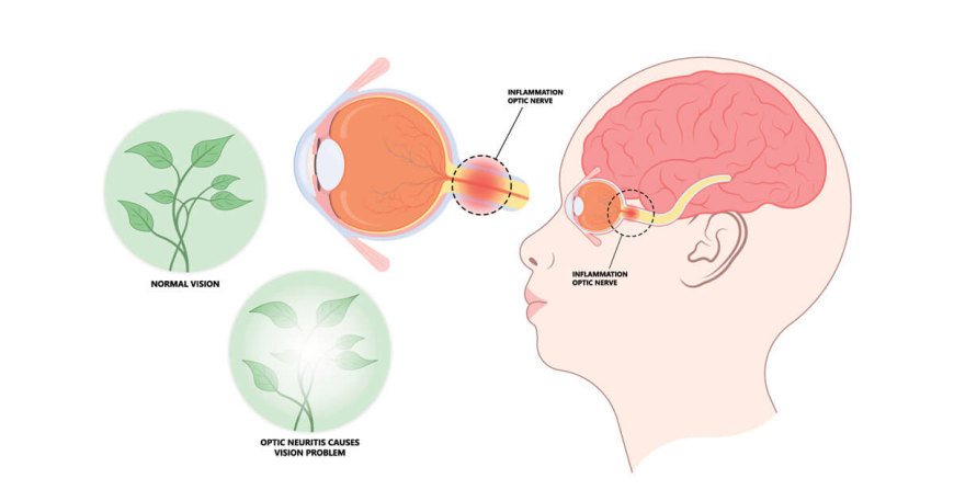 Neuromyelitis Optica Market: Size, Trends, and Strategic Insights to 2032