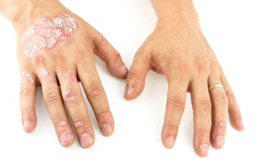 Chronic Plaque Psoriasis Market Growth, Trends, and Strategic Insights