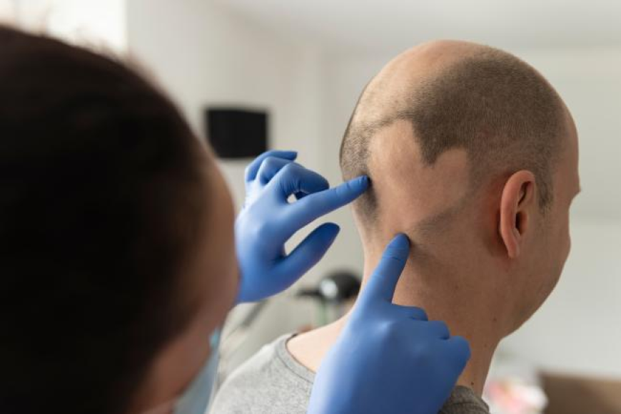 Alopecia Areata Treatment Market Growth and Dynamics 2025-2032