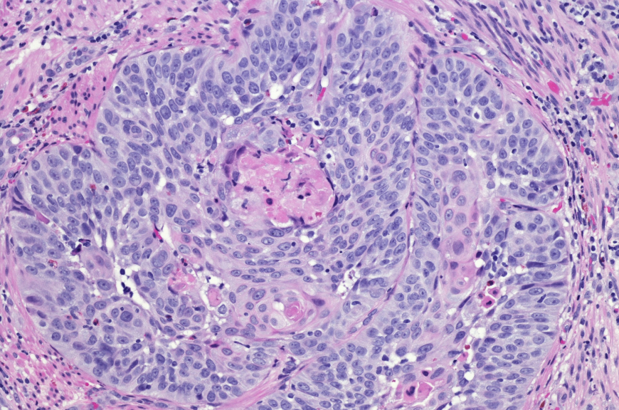 Advanced Non-Squamous and Squamous NSCLC Market: Size, Trends, and Growth Outlook