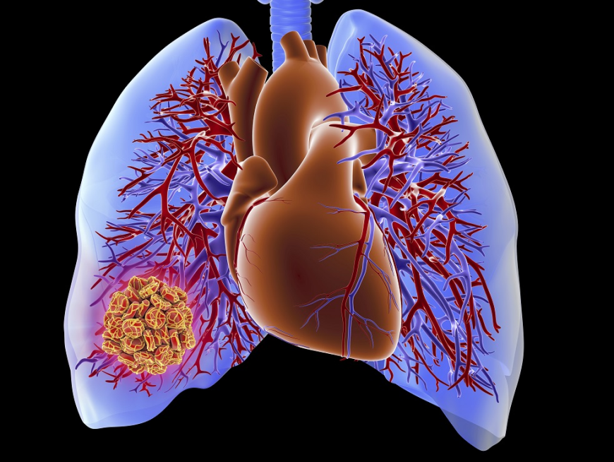 Chronic Thromboembolic Pulmonary Hypertension (CTEPH) Market Size, Growth, and Opportunities