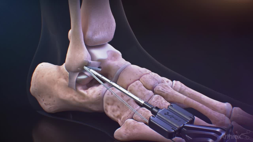 Joint Reconstruction Devices Market Size, Trends, and Growth Analysis 2025-2032