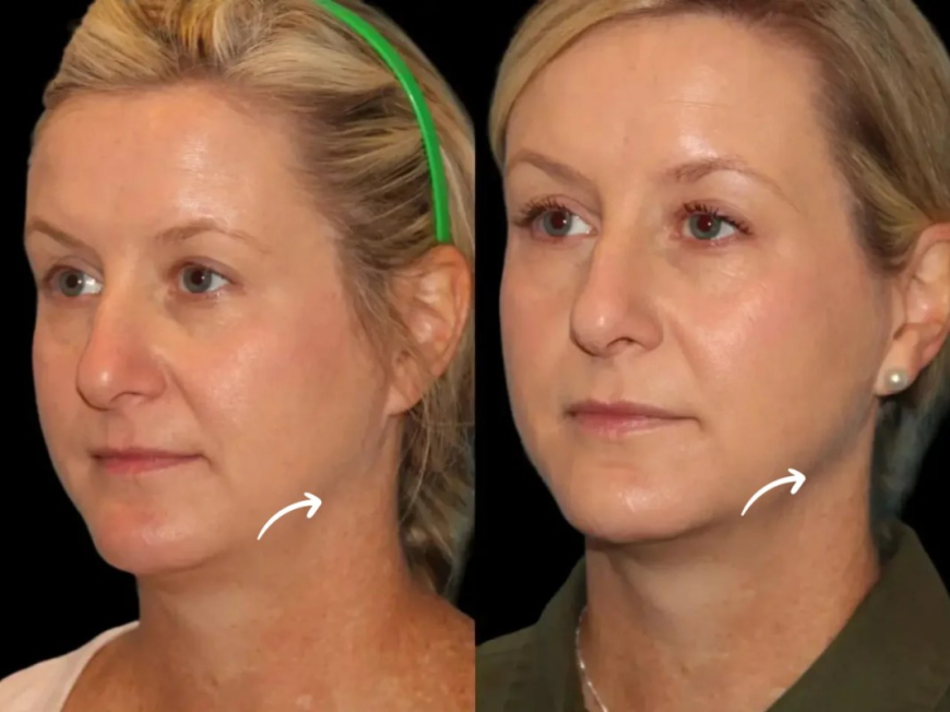 How international collaborations shaped Sculptra fillers use by Best Doctors in Dubai