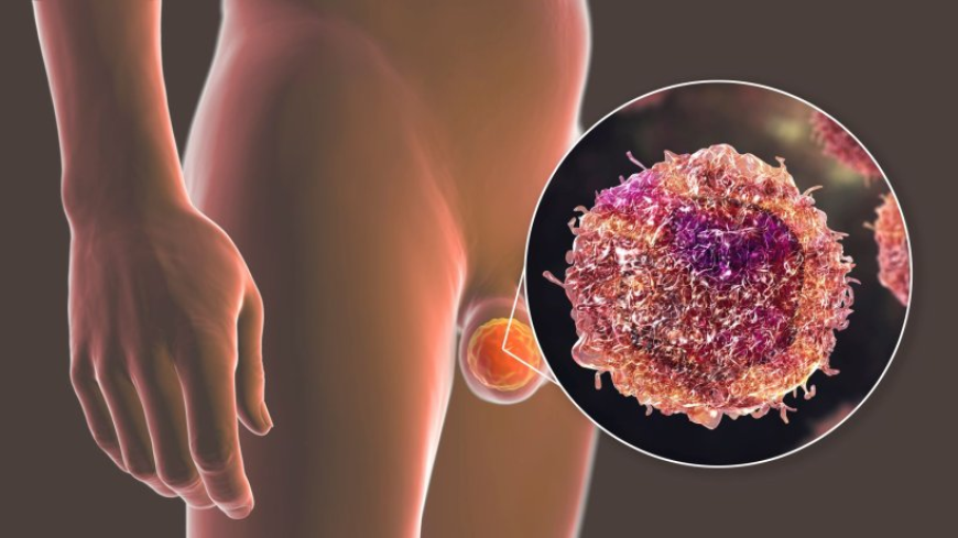 Rapid Expansion of the Testicular Cancer Drugs Market Forecast to 2032