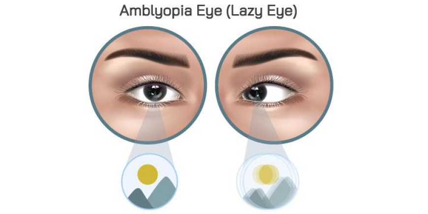 Global Amblyopia Market Growth, Trends, and Opportunities 2025-2032