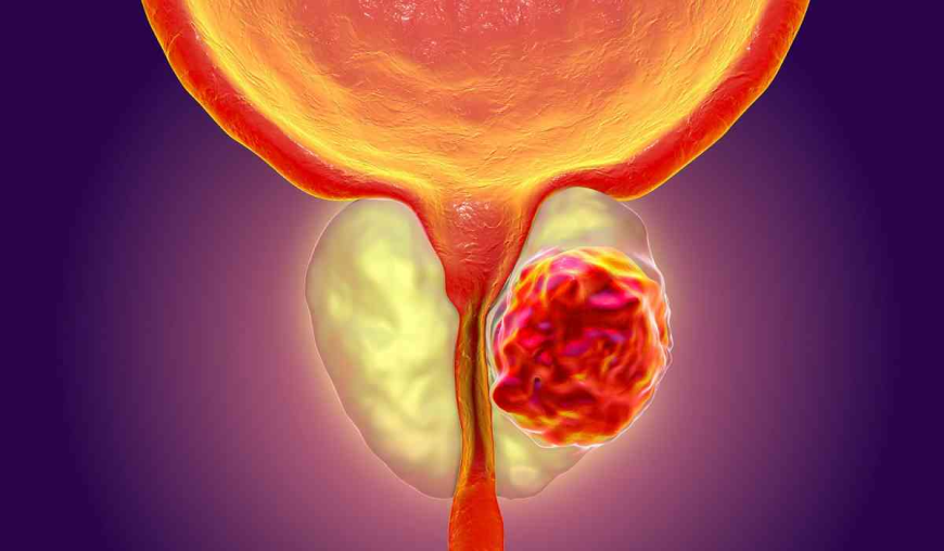 Neuroendocrine Prostate Cancer Market: Size, Trends, and Growth Opportunities