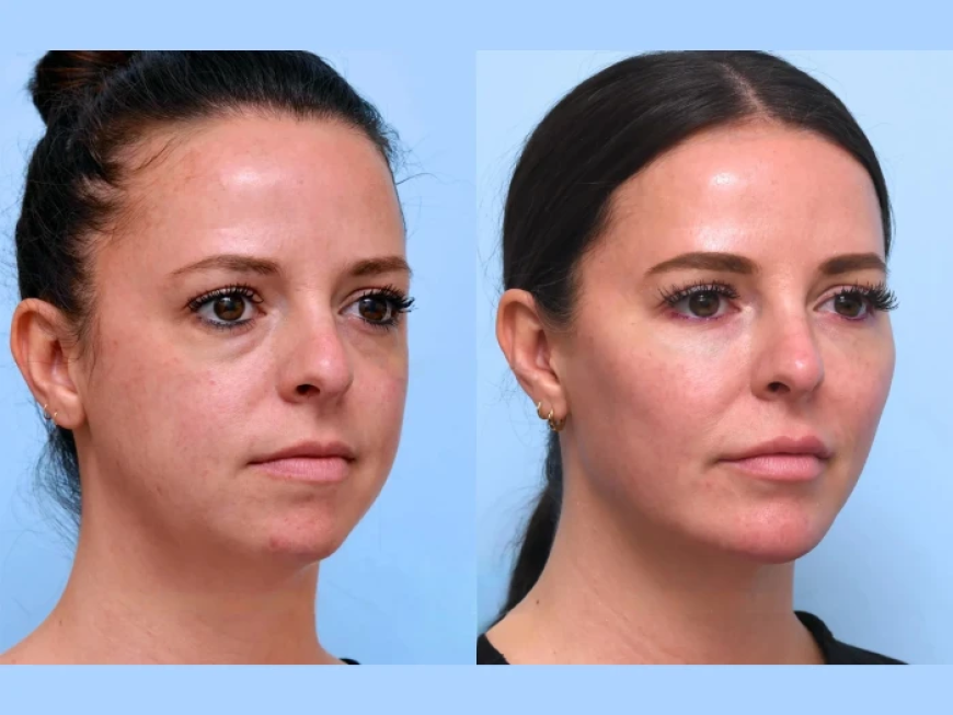 Best Plastic Surgeons in Dubai: Get Youthful Skin with a Thread Lift