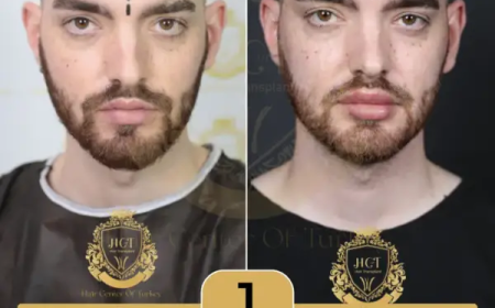 Transform Your Look with a Hair Transplant in Istanbul