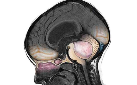 Medulloblastoma Drug Market: Size, Trends, Growth, and Opportunities