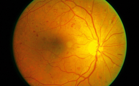 Proliferative Diabetic Retinopathy Market Size, Trends, and Growth Outlook 2025-2032