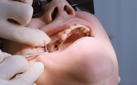 The Role Of Dental Implants In Preventing Bone Loss