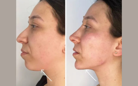 Embrace Radiance and Definition with Endolift Treatments in Dubai