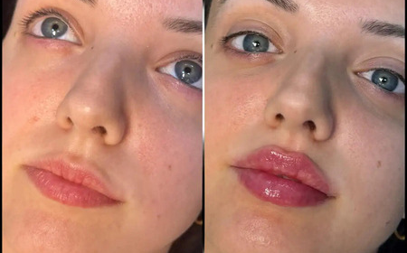 Best Aesthetic Clinic in dubai for Subtle and Elegant Fillers