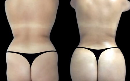 Best Aesthetic Clinic in dubai: Why Choose Hyacorp Fillers Over Surgery