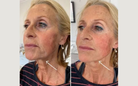 How the Best Doctors in Dubai Deliver Long-Lasting Results with Endolift