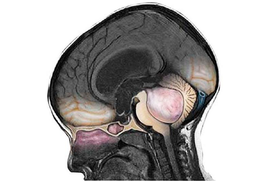 Medulloblastoma Drug Market: Size, Trends, Growth, and Opportunities