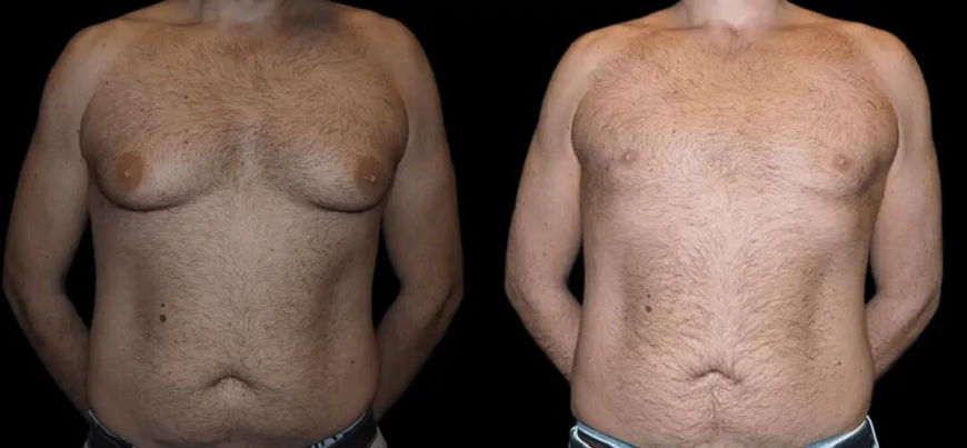 Best Gynecomastia Surgeons in dubai for Scarless Results