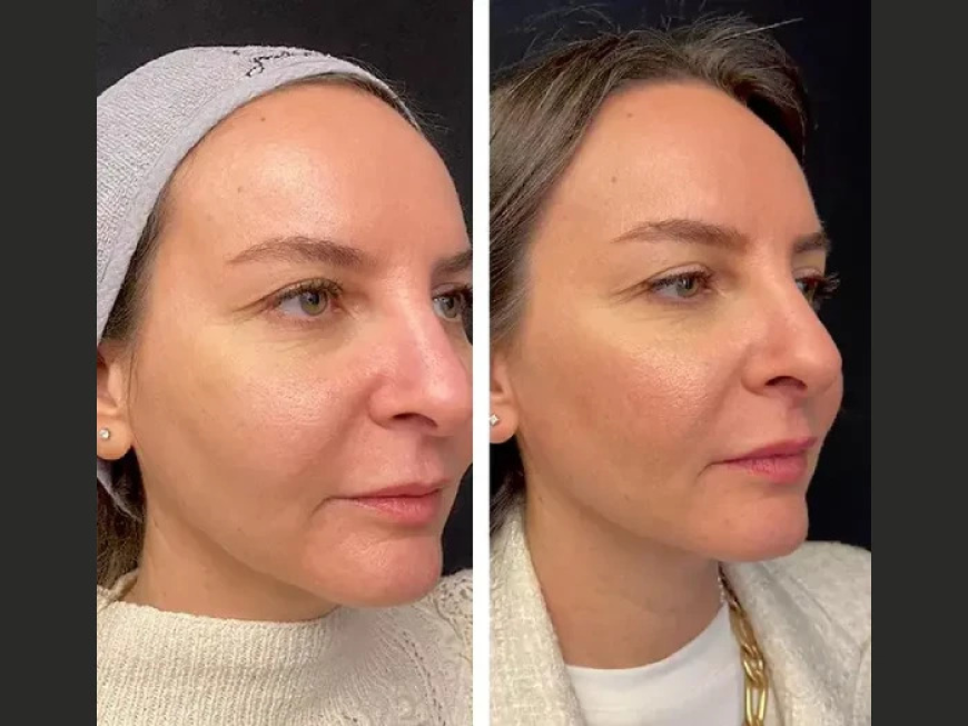 Best Plastic Surgeon in Dubai Highlights Mesotherapy for Wrinkle Reduction