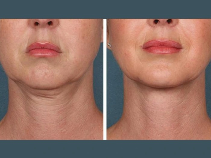 Best Aesthetic Clinic in Dubai for PRP Injection: Benefits for Facial Glow