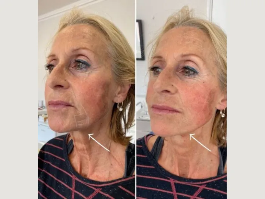 How the Best Doctors in Dubai Ensure Safe Endolift Procedures