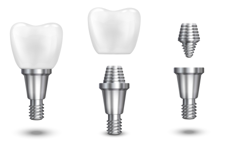 Why Dental Implants Can be a Smart Choice for a Confident Smile