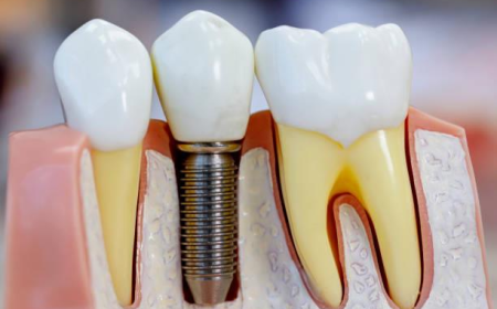 Your Complete Guide to Restoring Your Perfect Smile with Dental Implants