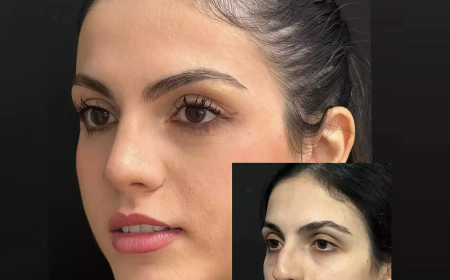 How Rhinoplasty in Dubai Boosts Confidence and Self-Image