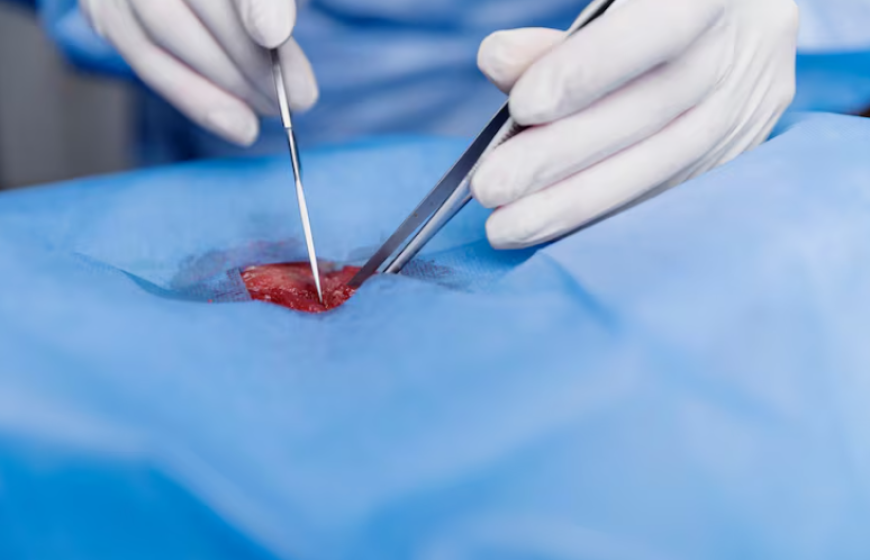 How Effective Is Large Vessel Occlusion (LVO) Treatment in Improving Stroke Outcomes?