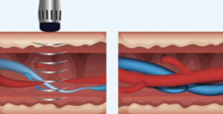 Extracorporeal Shockwave Therapy for Trigger Points and Muscle Stiffness