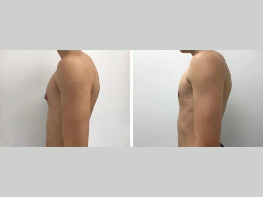 Getting Rid of Man Boobs with the Best Gynecomastia Surgeons in dubai