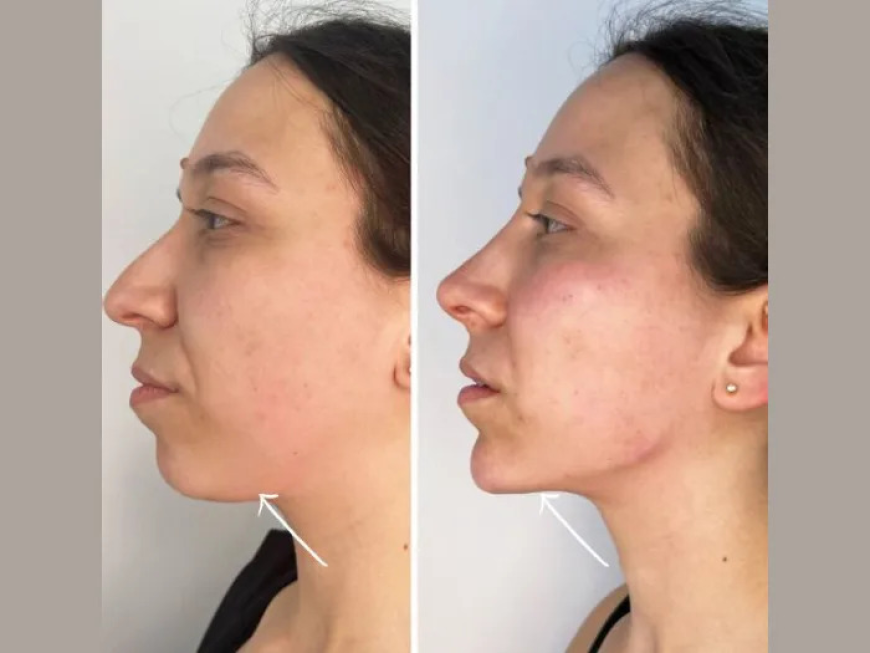 Discover Radiant Confidence with Endolift Treatment in Dubai