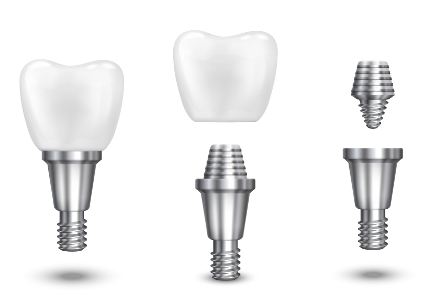 Why Dental Implants Can be a Smart Choice for a Confident Smile