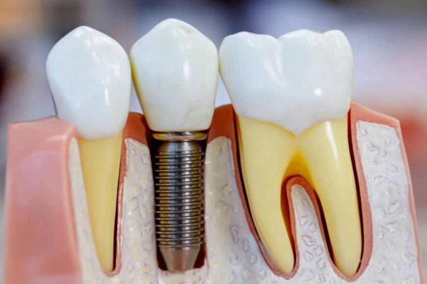 Your Complete Guide to Restoring Your Perfect Smile with Dental Implants