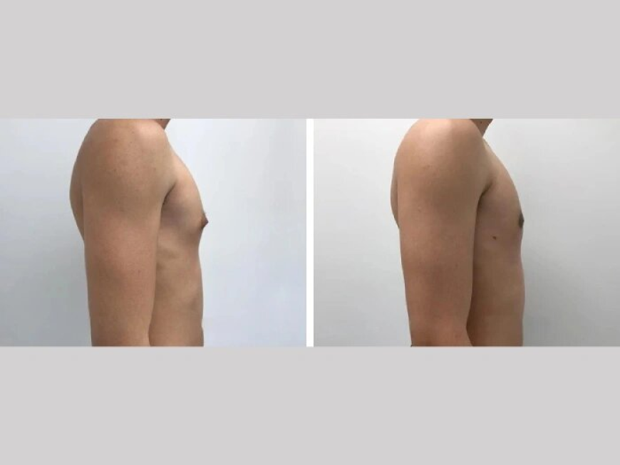 Best Gynecomastia Surgeons in dubai: Expert Care for Men