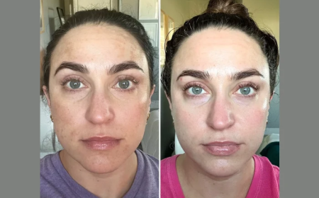 Smooth, Tight, and Radiant Skin Through Fotona 4D Laser in Dubai