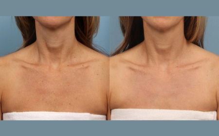 Safe and Effective Results from Moxi Laser Treatment in Dubai