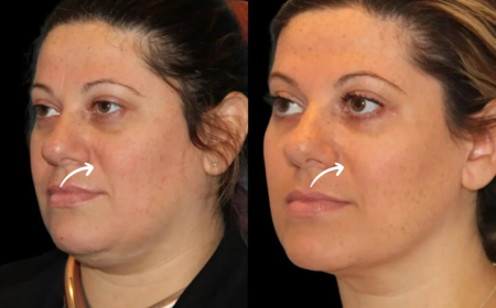 Sculptra Jawline Softening by Best Plastic Surgeon in Dubai