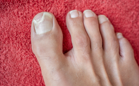 Broken Toenail Treatment: Steps to Heal and Prevent Infection
