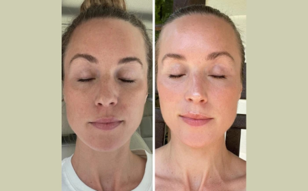 How to Choose the Best Aesthetic Clinics in Dubai Fotona 4D Laser for You