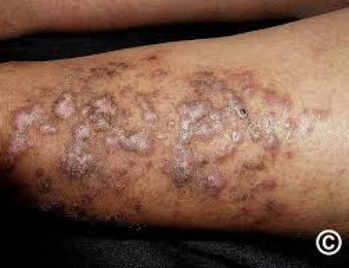 Lichen Planus Herbal Cure: Effective Natural Solutions