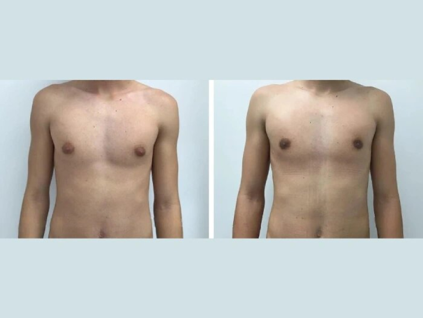 Best Gynecomastia Surgeons in dubai for Top-Rated Results