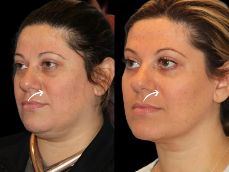 Sculptra Jawline Softening by Best Plastic Surgeon in Dubai