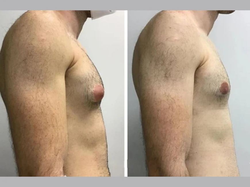 Best Gynecomastia Surgeons in dubai with Verified Transformations