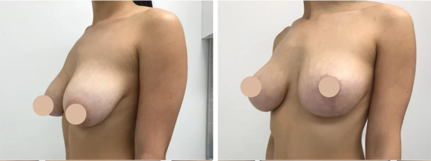 Breast Lift in Dubai Guide to Cost and Recovery