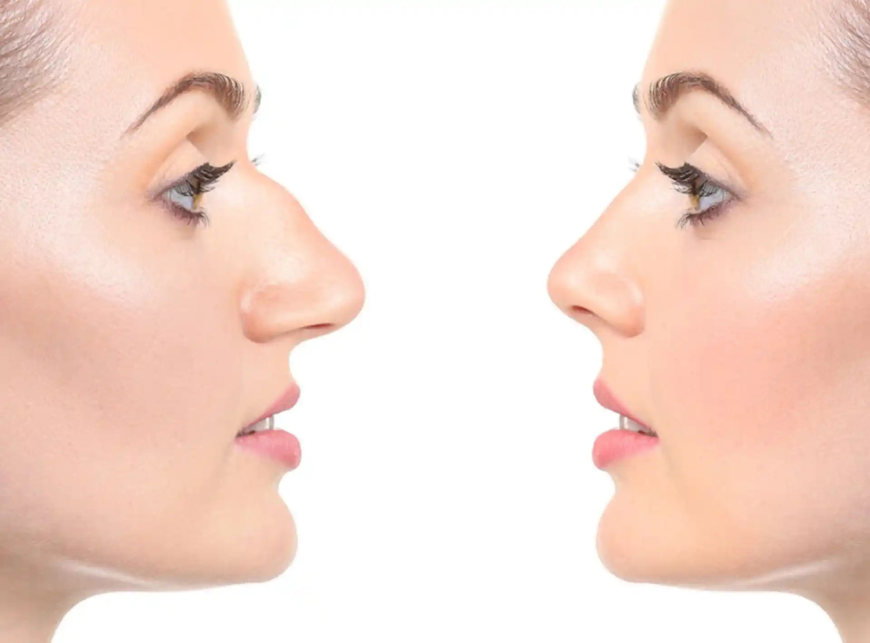 Confidence Begins with the Best Rhinoplasty Surgeon in Dubai