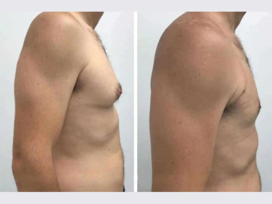 The Real Cost of Gynecomastia Surgery in dubai: Value Over Price