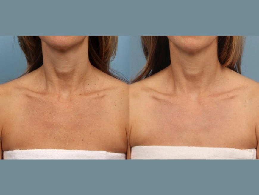 World-Class Moxi Laser Treatment at the Best Aesthetic Clinics in dubai