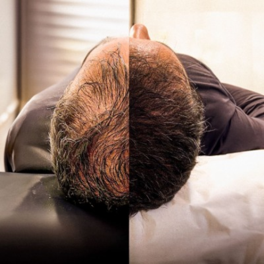 Restore Your Confidence with Hair Transplant in Islamabad